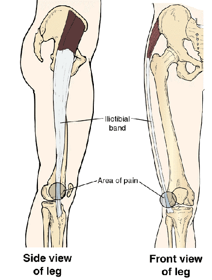 iliotibial_band_friction_syndrome2